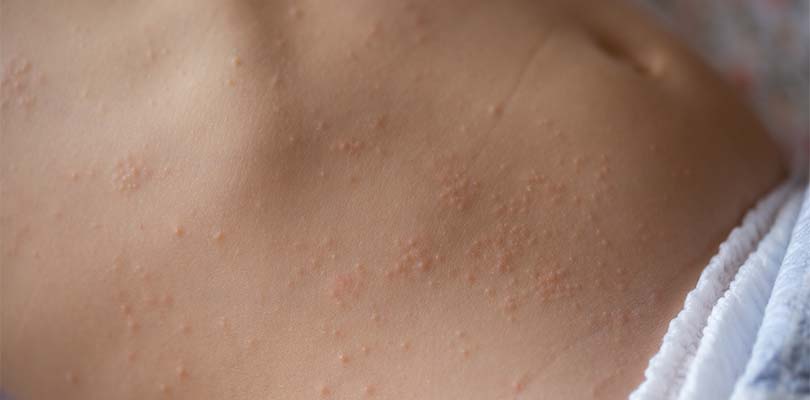 Sixth Disease: Causes, Symptoms and Treatment Options